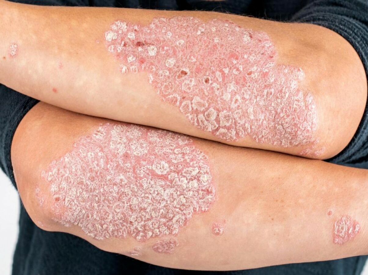 psoriasi come si cura