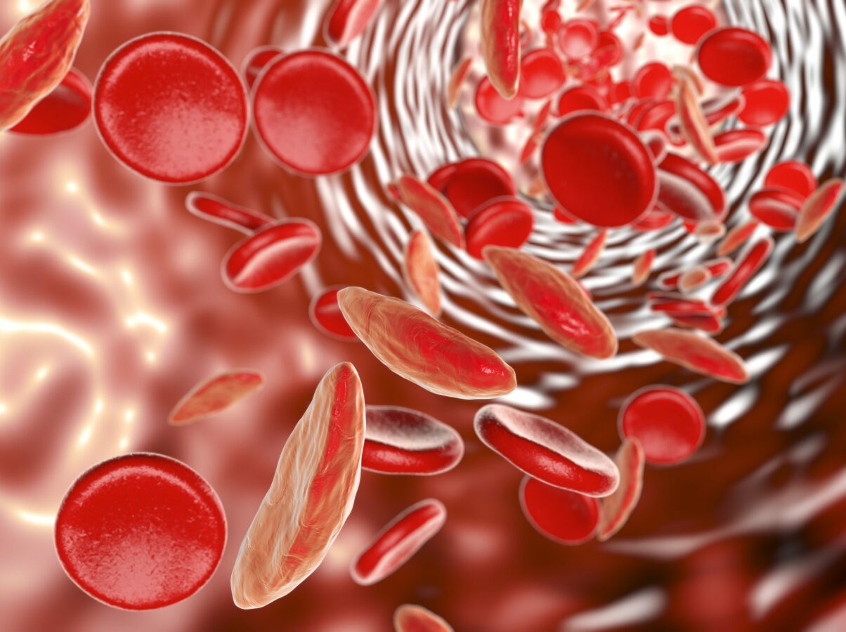 anemia