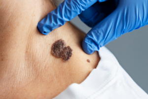 osservazione neo per rilevamento differenza tra neo e melanoma